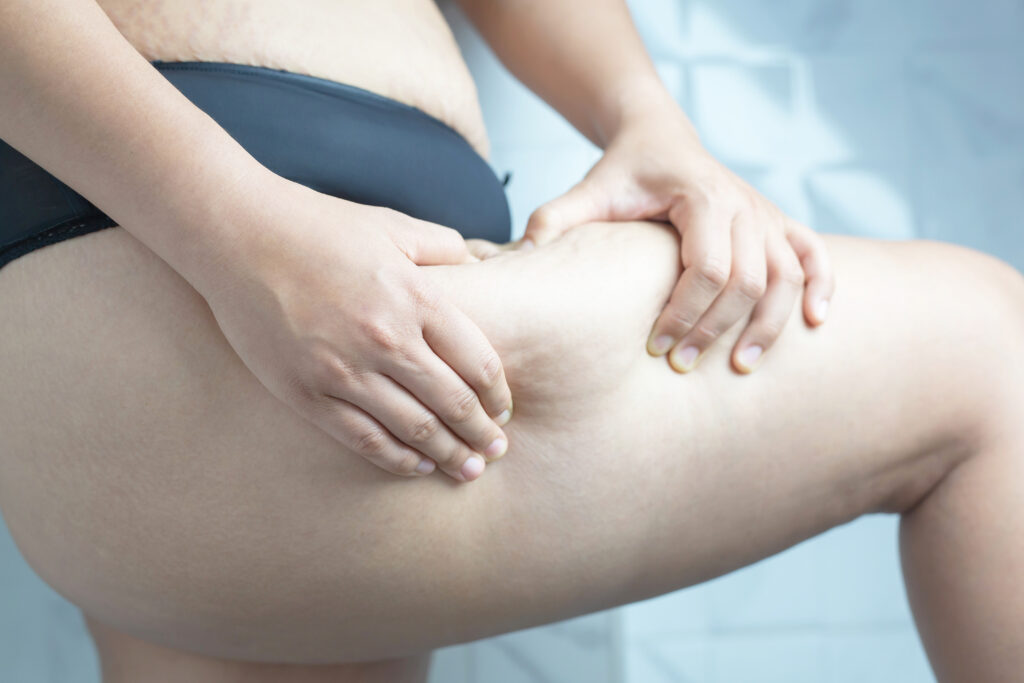 Diferença entre celulite e lipedema